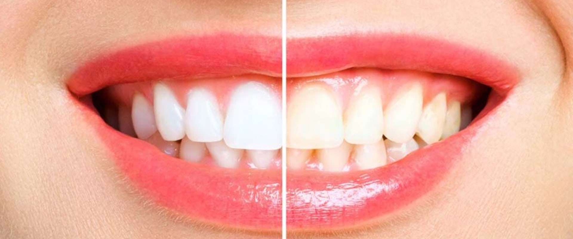 Lemon Juice and Salt Scrub: An At-Home Teeth Whitening Treatment