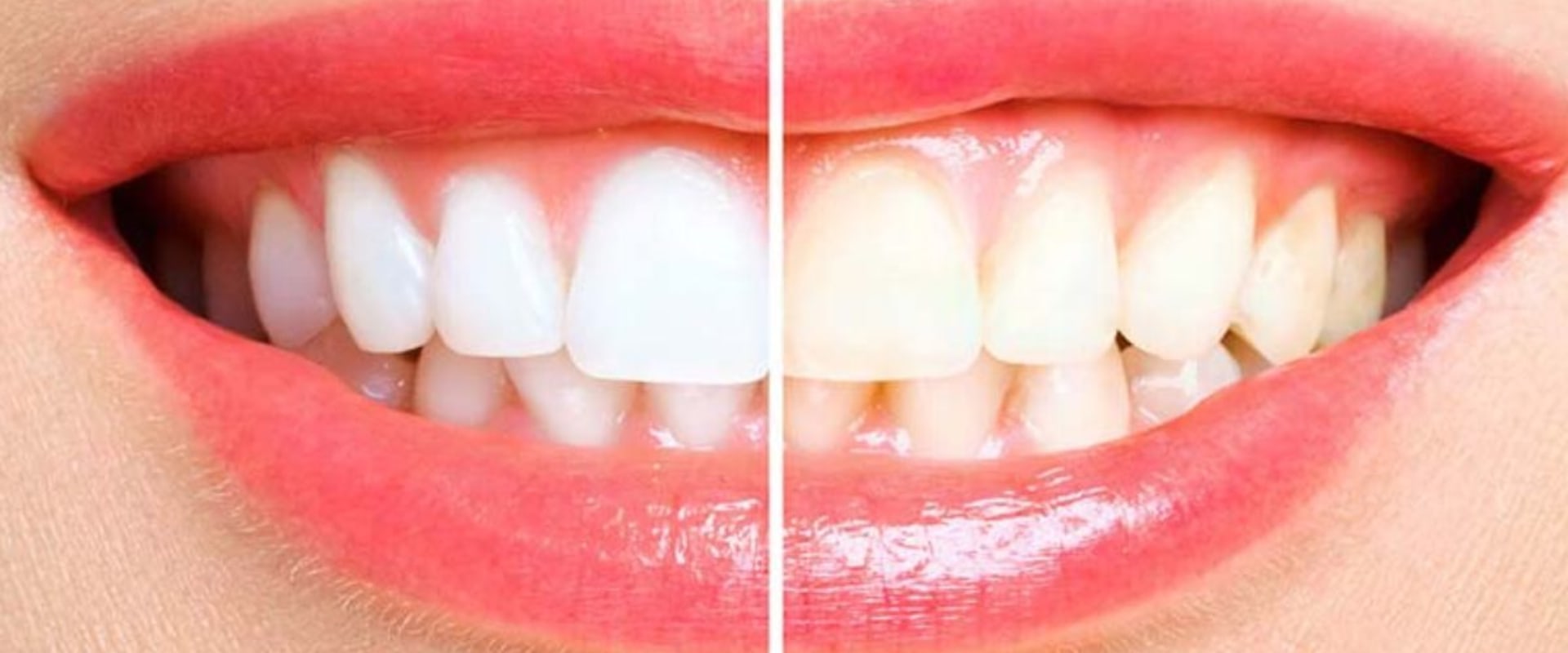Baking Soda and Hydrogen Peroxide Paste: Teeth Whitening Tips and At-Home Remedies