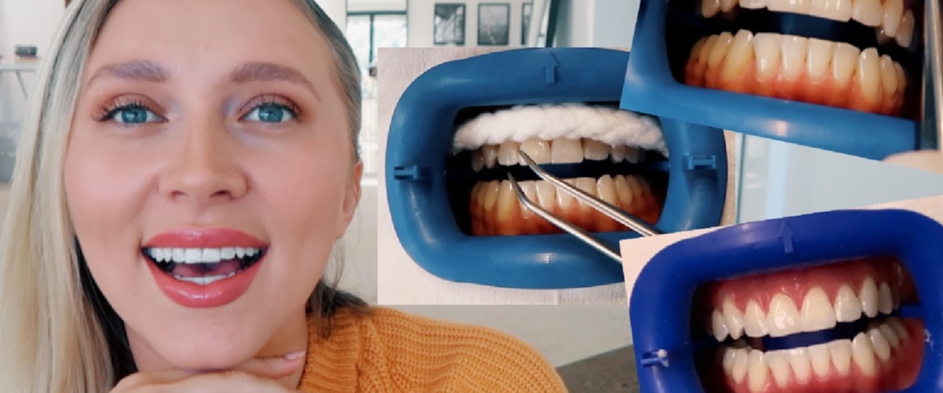 Reviews of In-Office Teeth Whitening Treatments