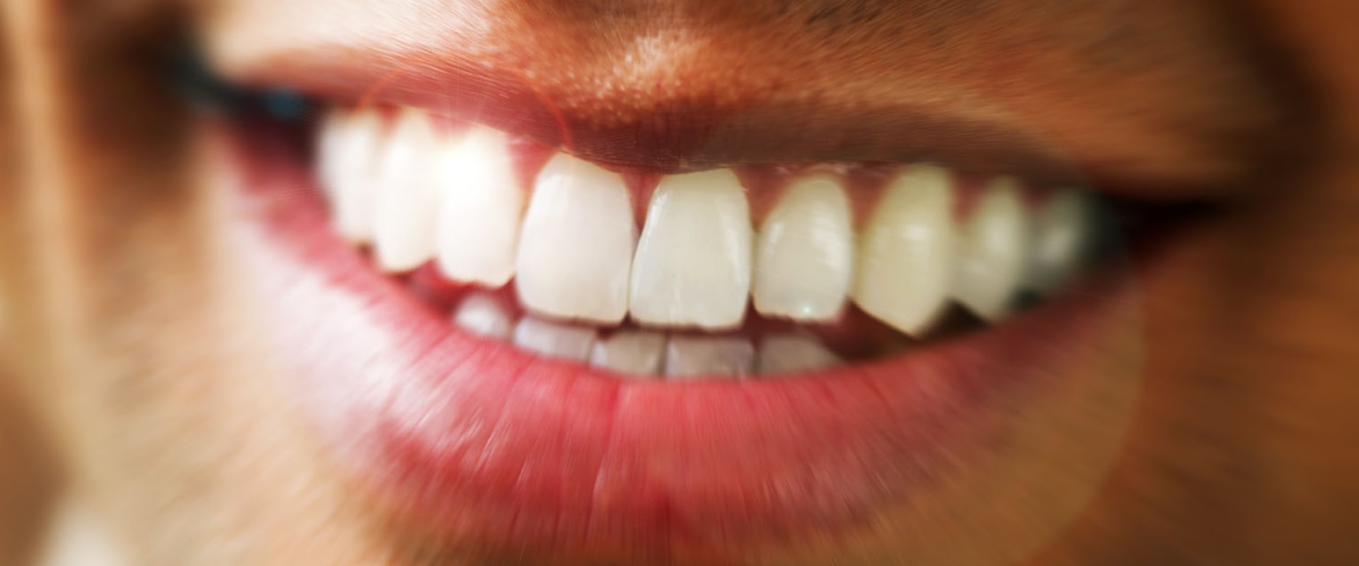 Take-home Kits: All You Need to Know About At-Home Teeth Whitening Treatments
