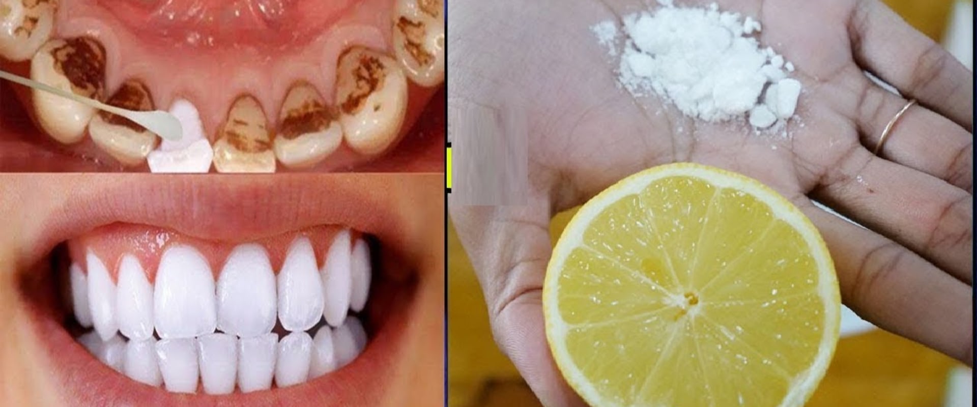 Baking Soda and Lemon Juice Paste: An All-Natural Teeth Whitening Remedy