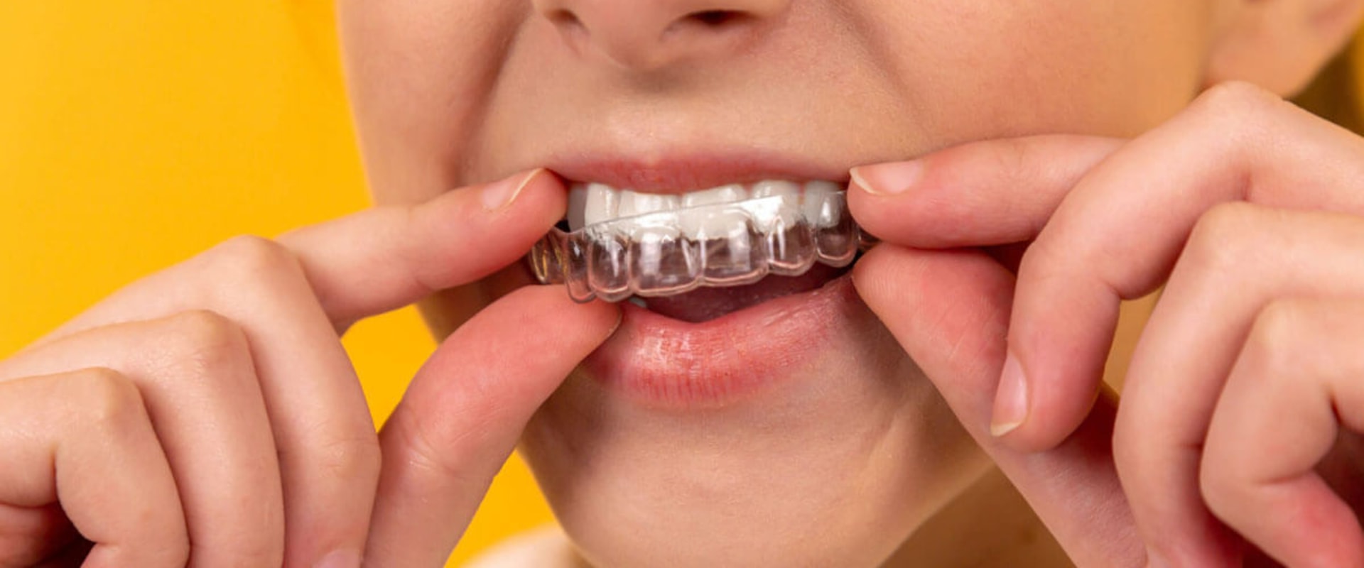 The Science Behind Whitening Gels and Trays