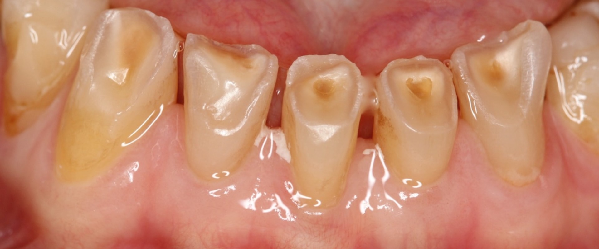 Stannous Fluoride: An Overview