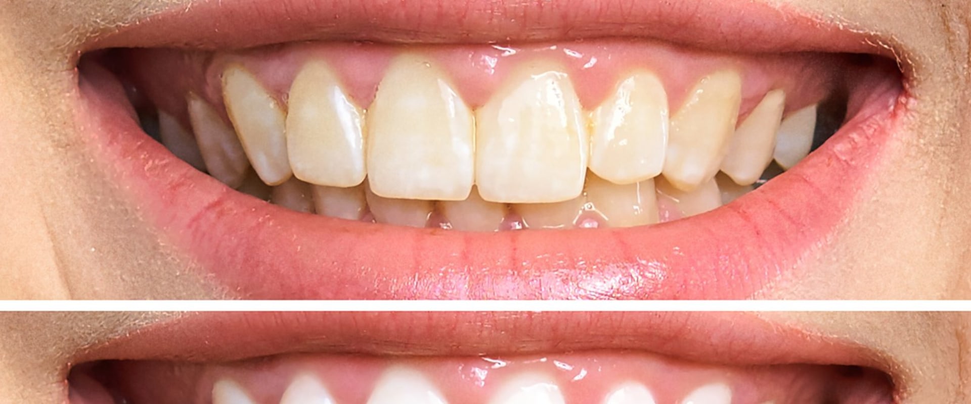 Teeth Whitening Results: Strips and Gels