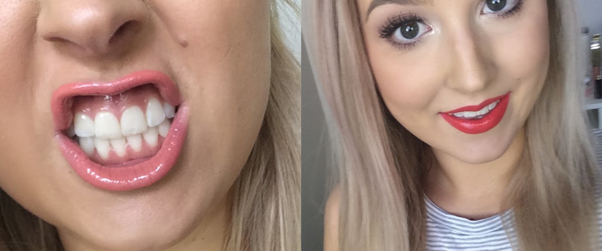 Coconut Oil Pulling for Whiter Teeth