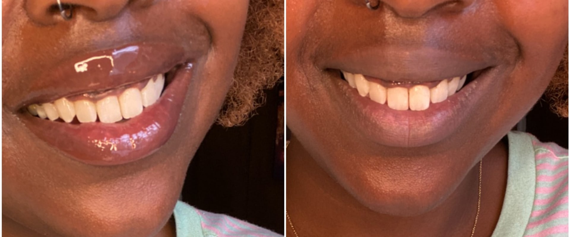 Whitening Pens: Exploring a Tooth Whitening Option
