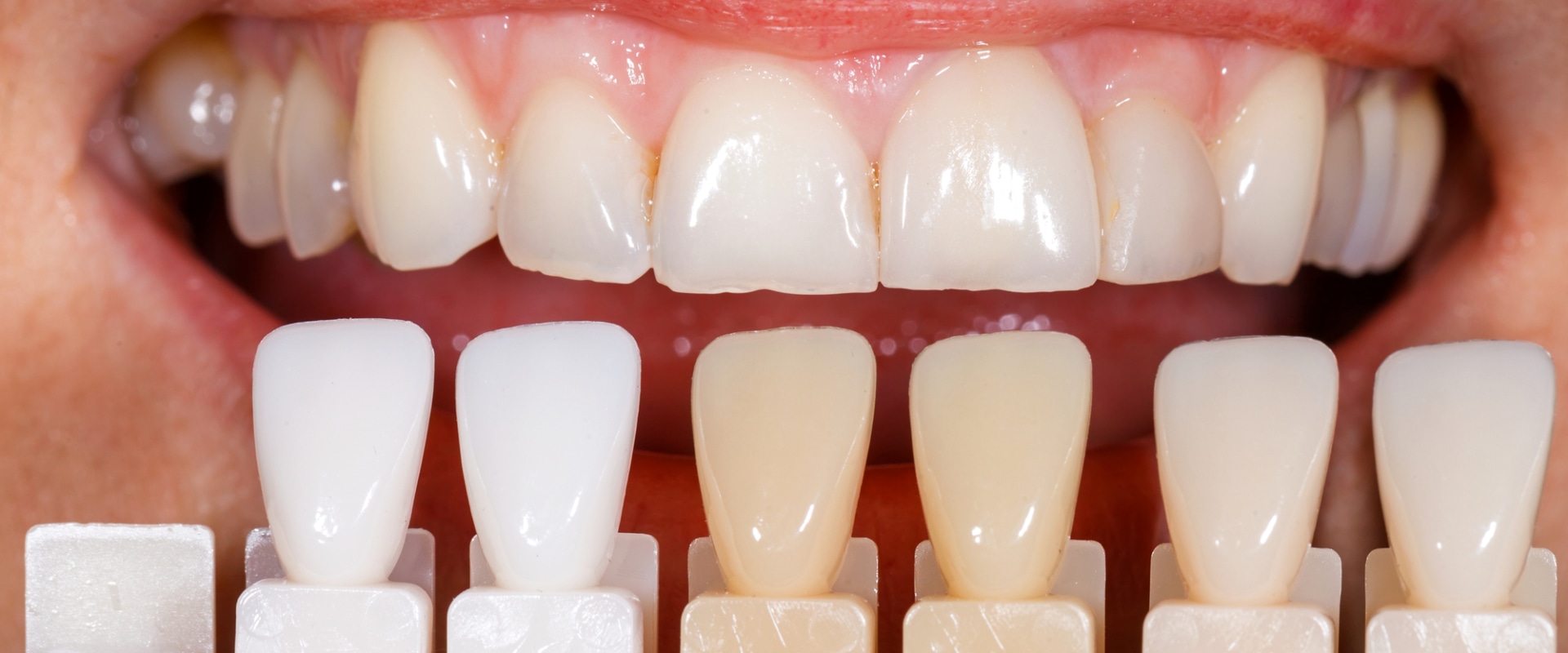 Everything You Need to Know About Veneers