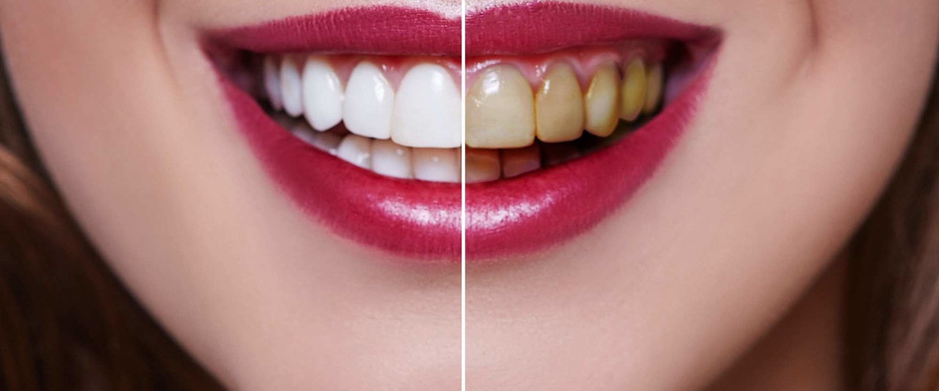 Laser Teeth Whitening Results: What to Expect