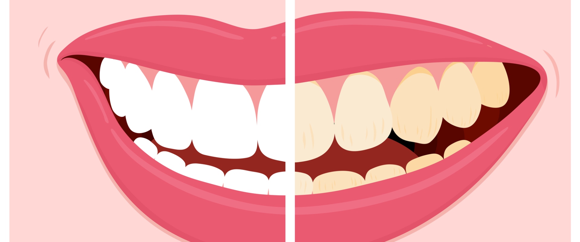 Tips to Avoid Stain-Causing Foods and Drinks for Teeth Whitening