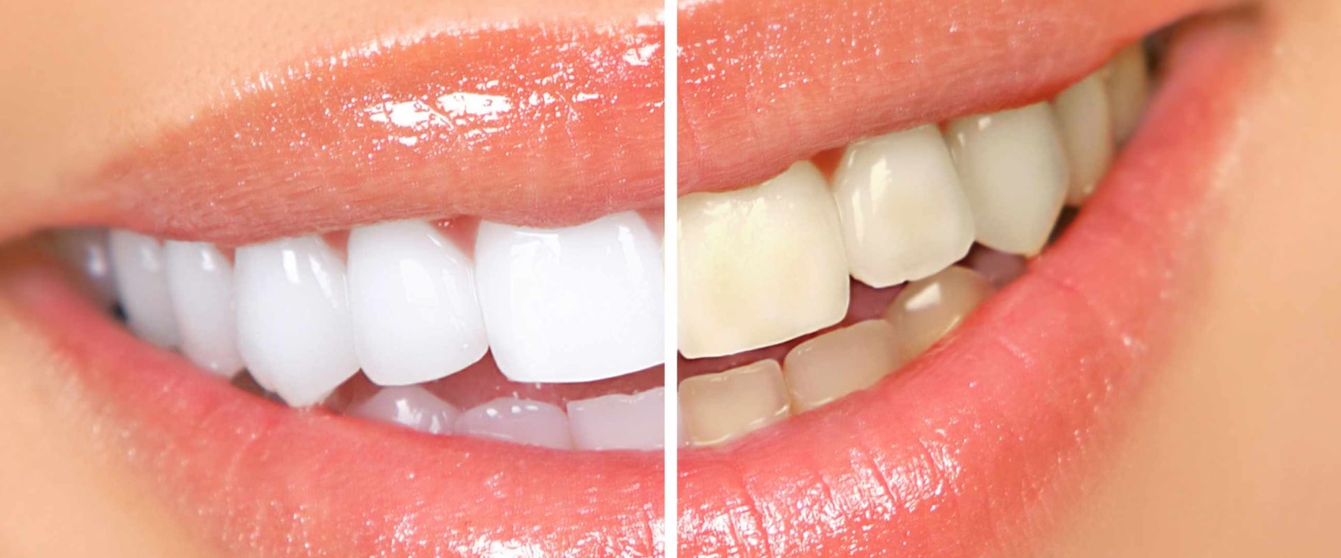 Tips for Using Whitening Toothpastes