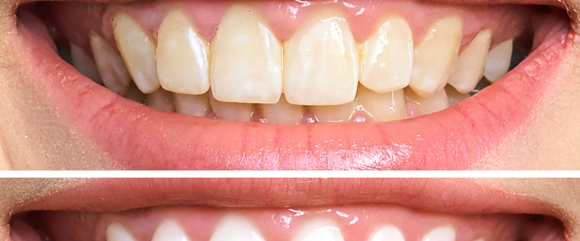 Maintaining Proper Dental Care for Whiter Teeth