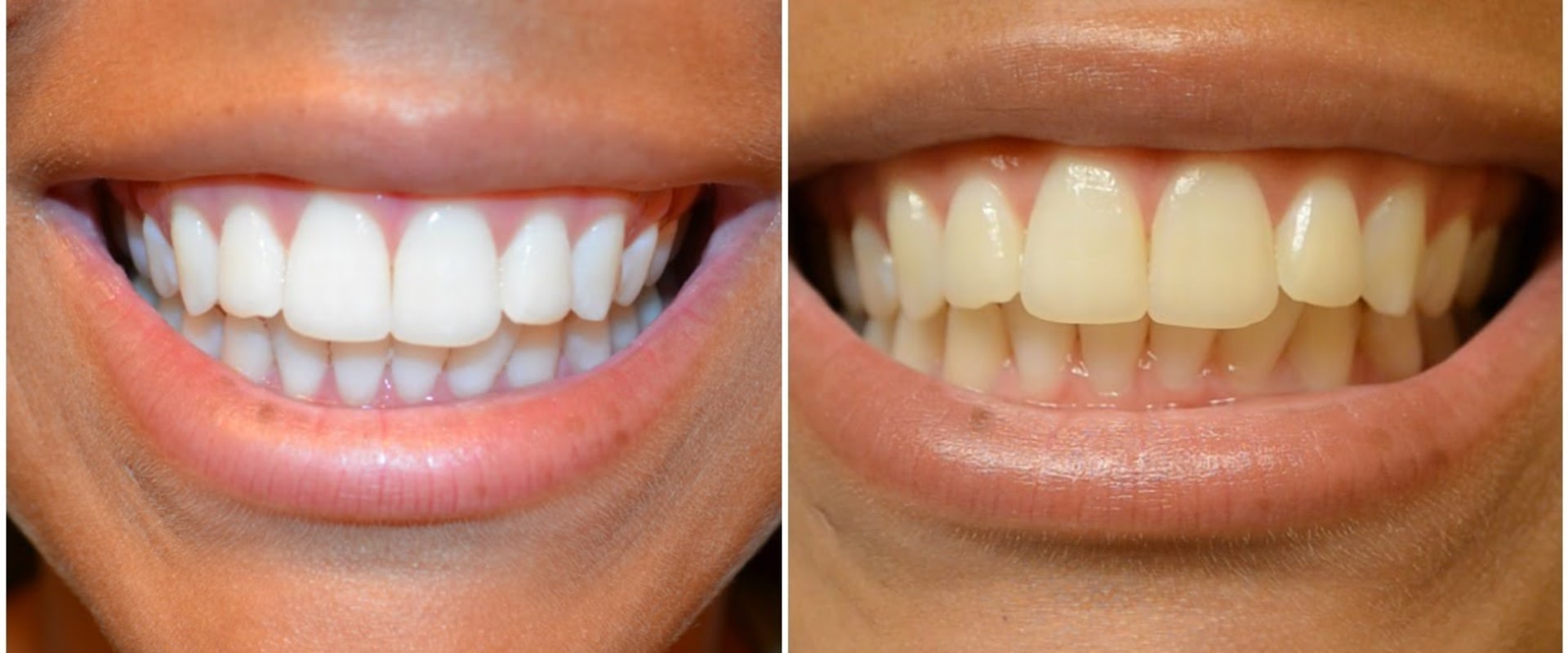 Reviews of Whitening Strips