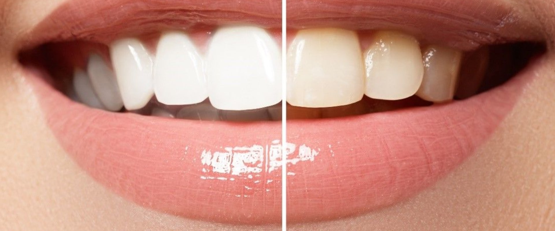 Veneers Results: What to Expect From Teeth Whitening Alternatives