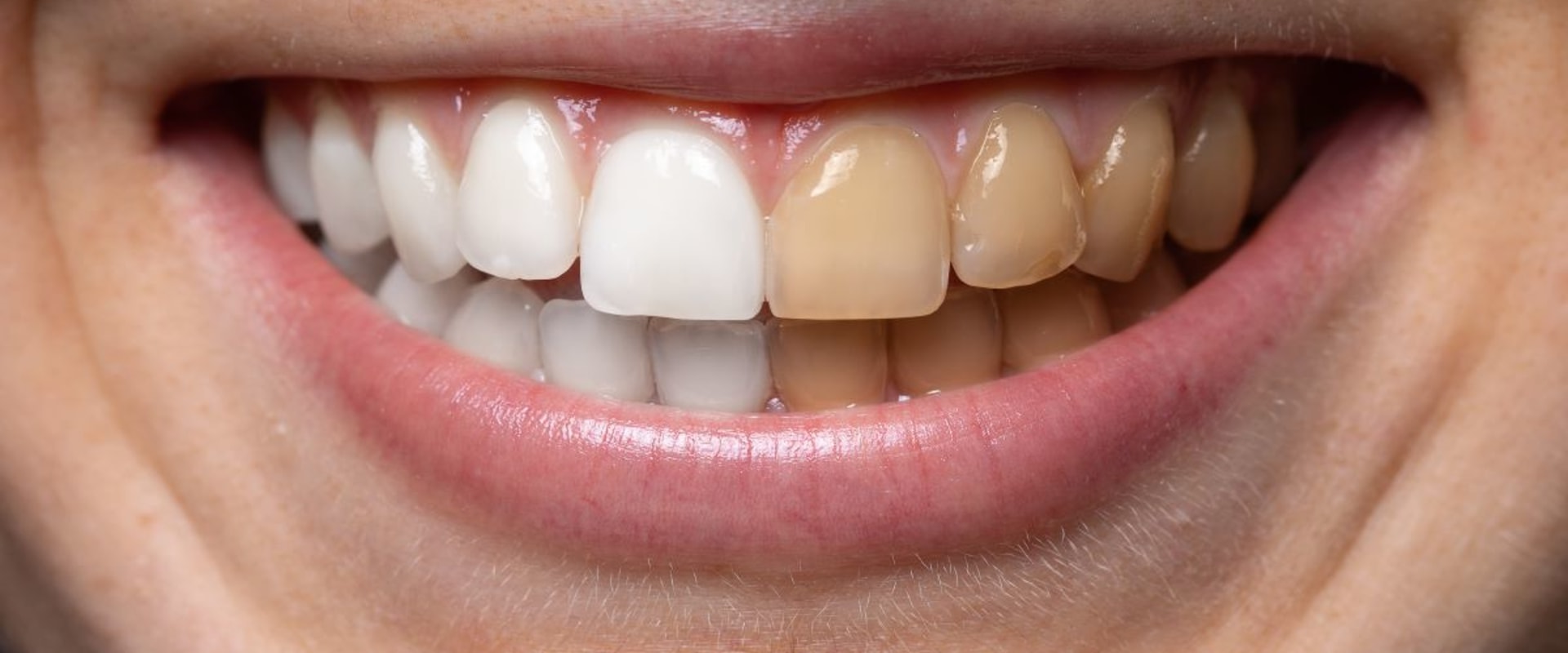 Expected Results from Whitening Toothpastes