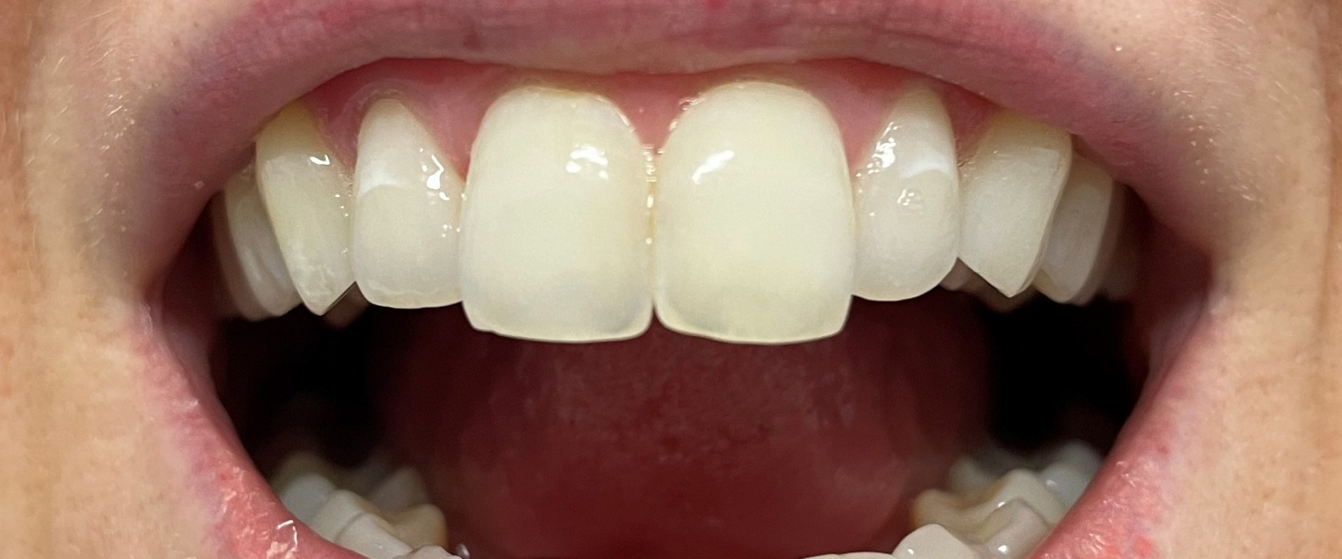 Enamel Reshaping: What to Know About the Teeth Whitening Alternative