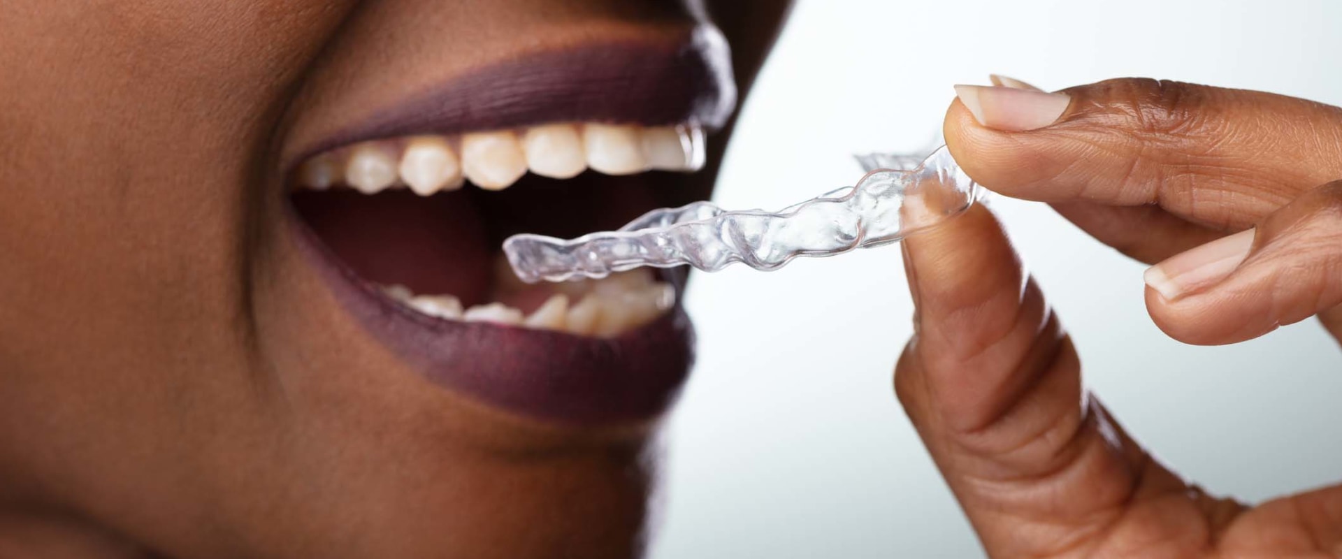 Whitening Gels: Types of Teeth Whitening Products