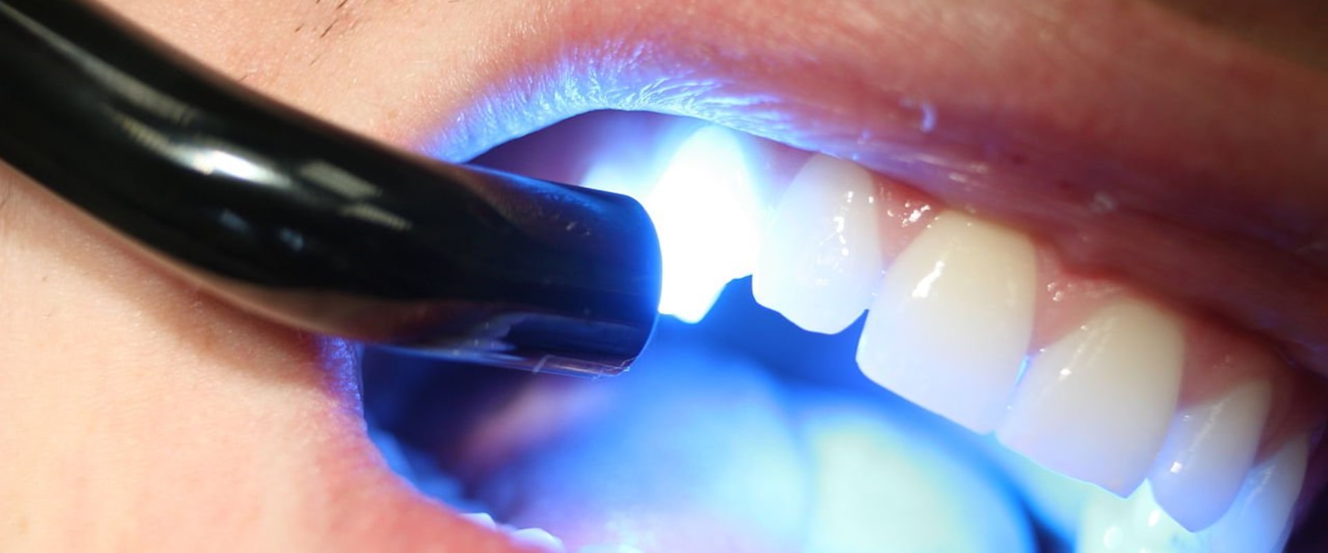 Dental Bonding Reviews: Understanding What it is and Its Alternatives