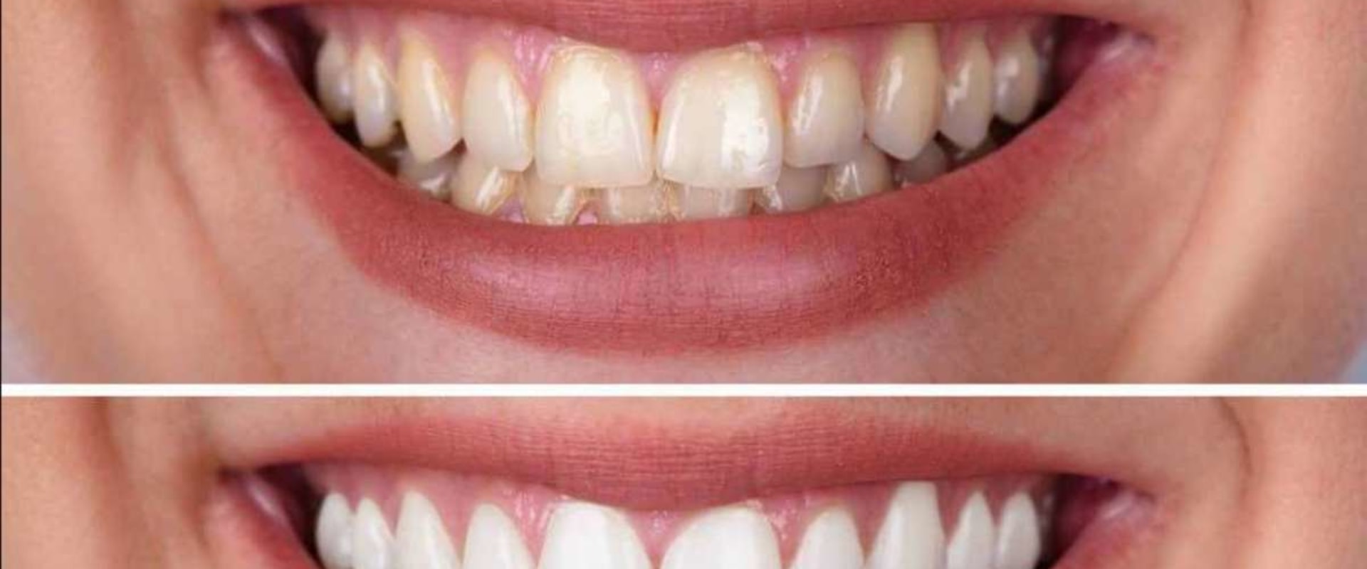 Kor Whitening Cost Breakdowns: An In-Depth Overview
