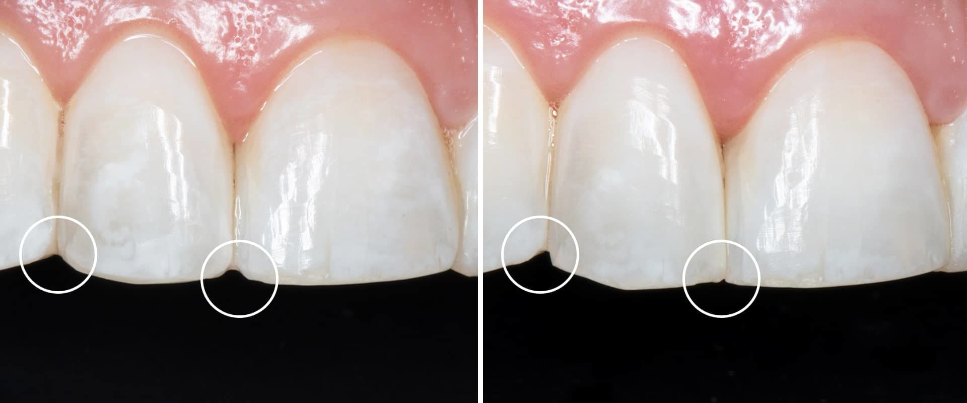 Enamel Reshaping Reviews