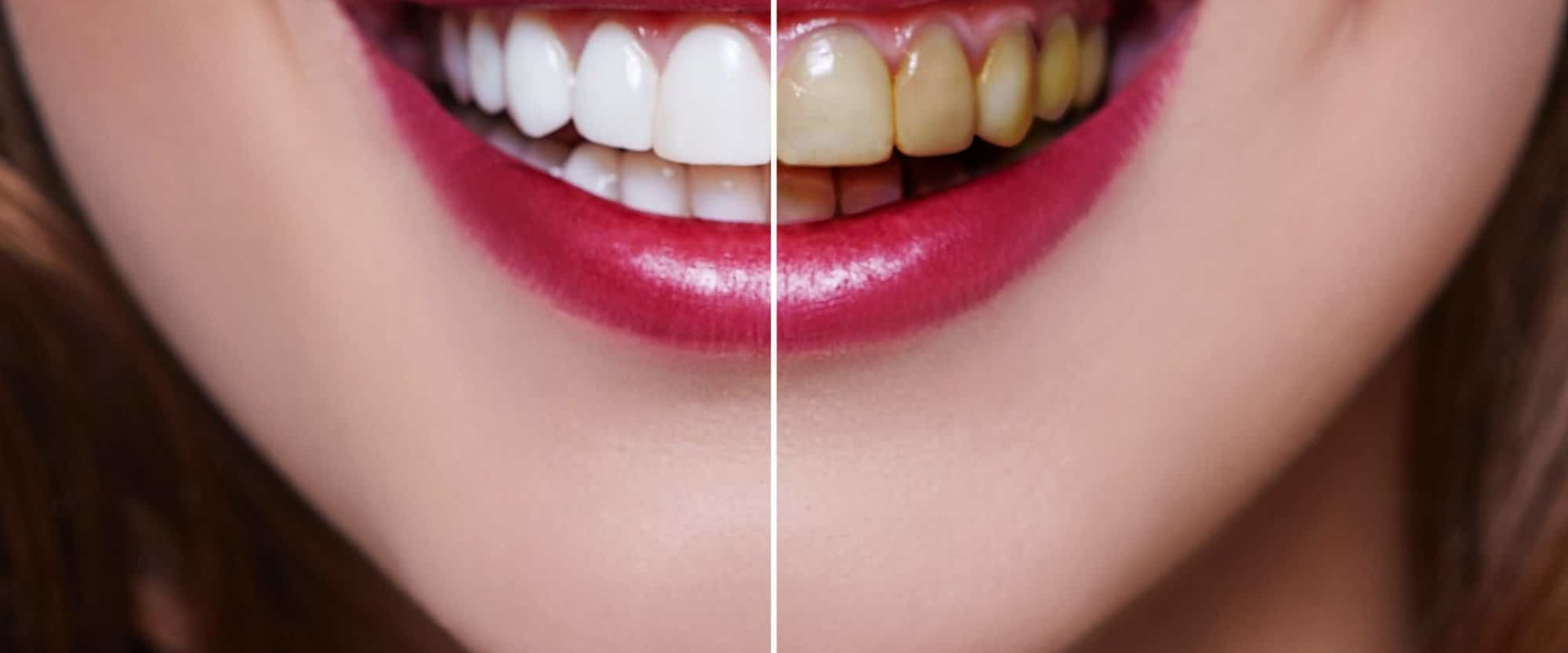 Understanding Expected Results from Professional Teeth Whitening Treatments