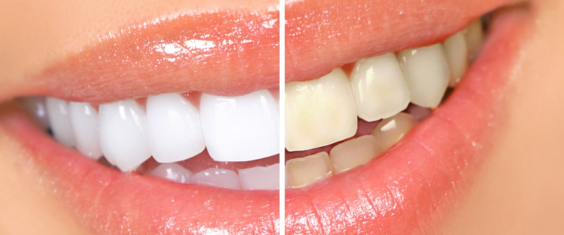 Kor Whitening Results: An Overview