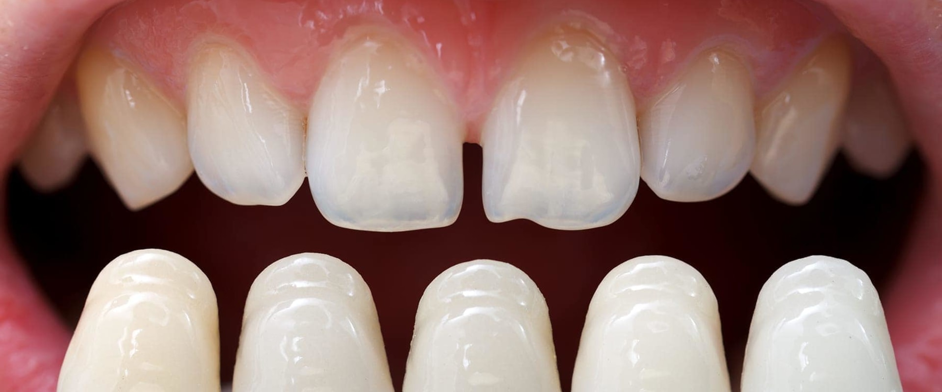 Veneers Reviews: All You Need to Know