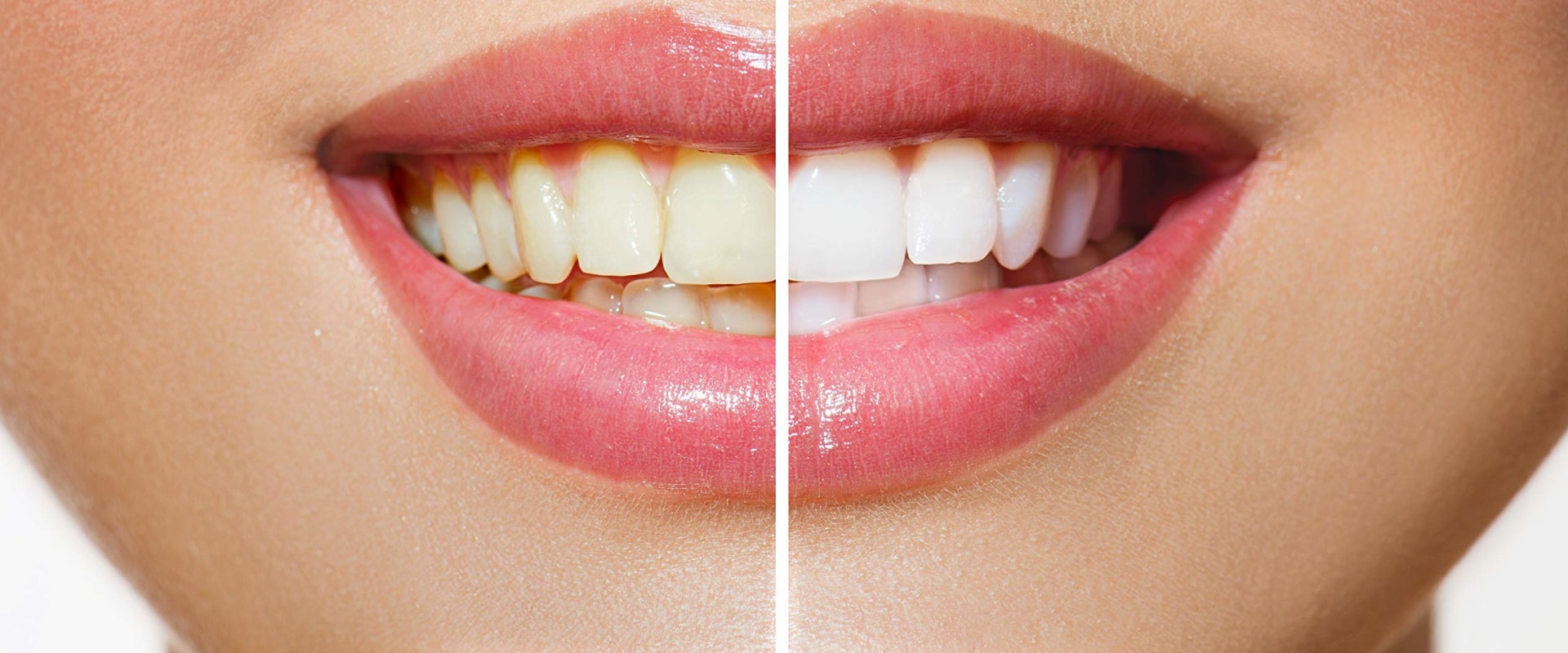 Teeth Whitening Cost: Toothpaste & Rinses Cost Breakdowns