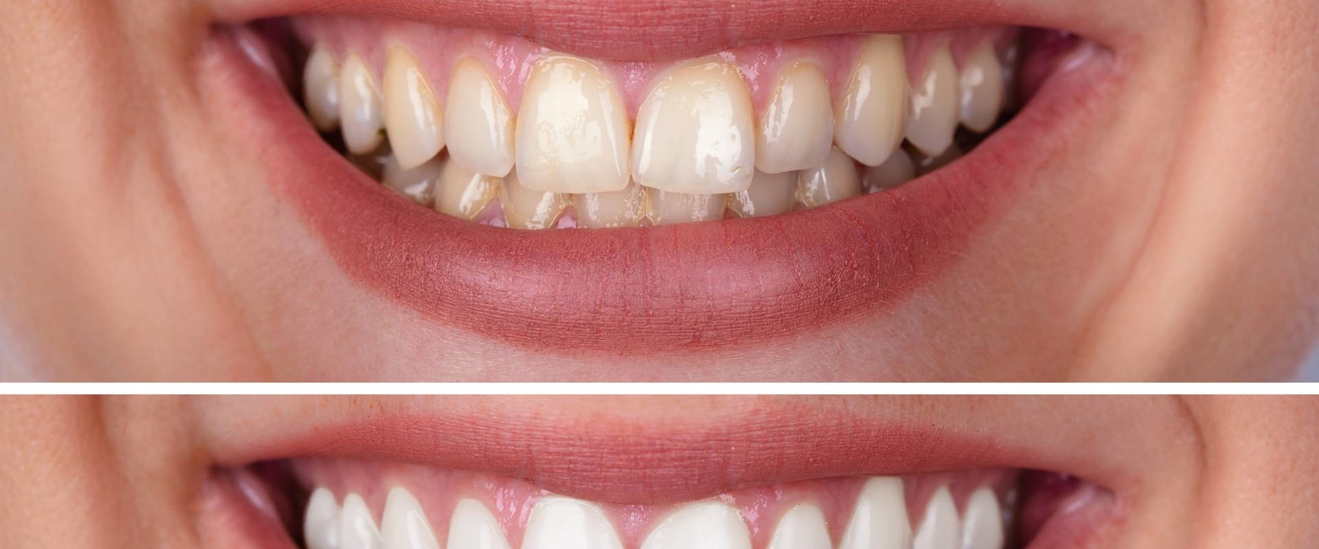 The Cost of Professional In-Office Teeth Whitening Treatments