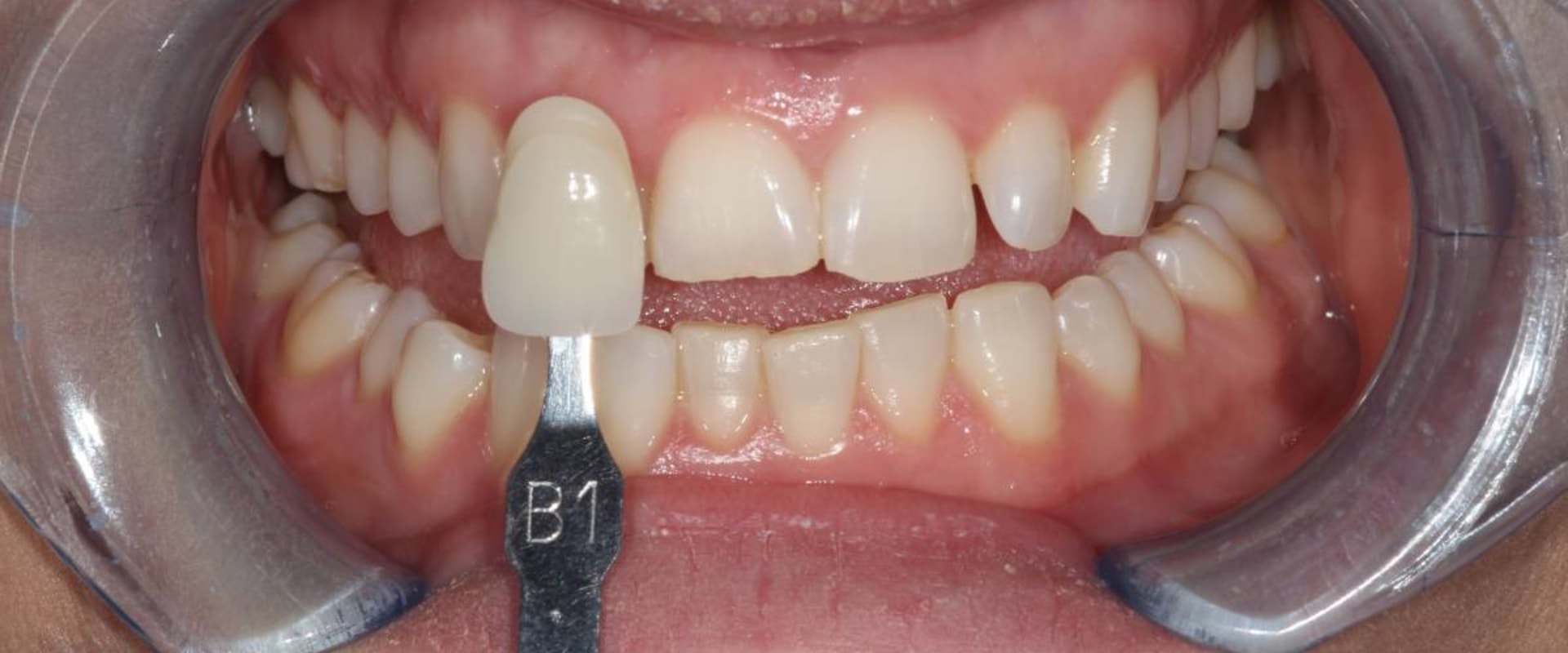 Foods and Drinks to Avoid for Whiter Teeth