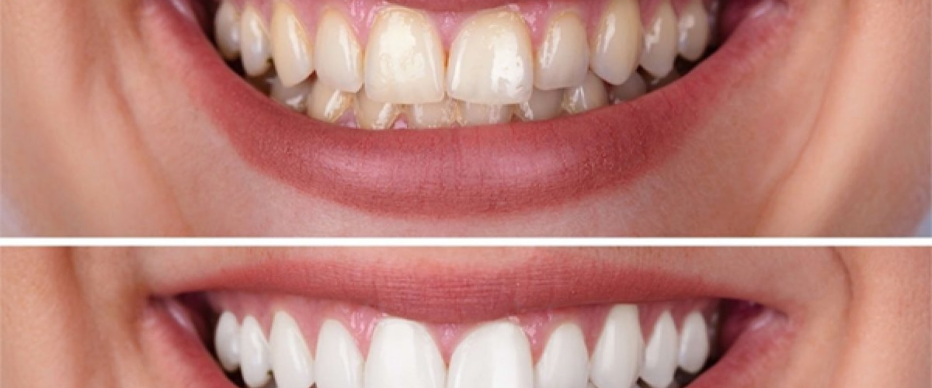 Pros and Cons of In-Office Teeth Whitening