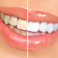Understanding Pros and Cons of Whitening Gels and Trays