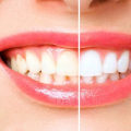 Lemon Juice and Salt Scrub: An At-Home Teeth Whitening Treatment