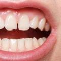 Dental Bonding Results: An Overview of What to Expect