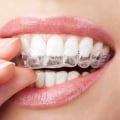 Everything You Need to Know About Whitening Strips