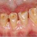 Stannous Fluoride: An Overview