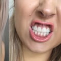 Coconut Oil Pulling for Whiter Teeth
