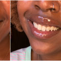 Whitening Pens: Exploring a Tooth Whitening Option