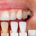 Everything You Need to Know About Veneers