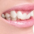 Understanding Enamel Reshaping Cost Breakdowns