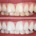 Cost of Whitening Gels and Trays