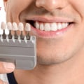 Hydrogen Peroxide: What You Need to Know About Teeth Whitening Products