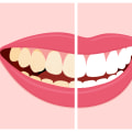Tips to Avoid Stain-Causing Foods and Drinks for Teeth Whitening