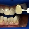 Laser Teeth Whitening: A Comprehensive Overview