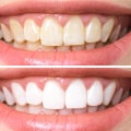 Maintaining Proper Dental Care for Whiter Teeth