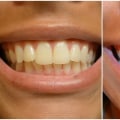 Reviews of Whitening Strips