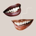 Dental Bonding Cost Breakdowns: An Informative Guide
