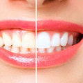 Reviews of Toothpastes and Rinses for At-Home Teeth Whitening Treatments