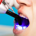 Dental Bonding: A Comprehensive Overview