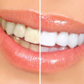 Carbamide Peroxide: A Comprehensive Overview