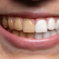 Expected Results from Whitening Toothpastes